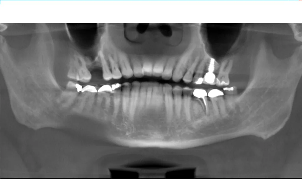 Panoramic x-ray before treatment