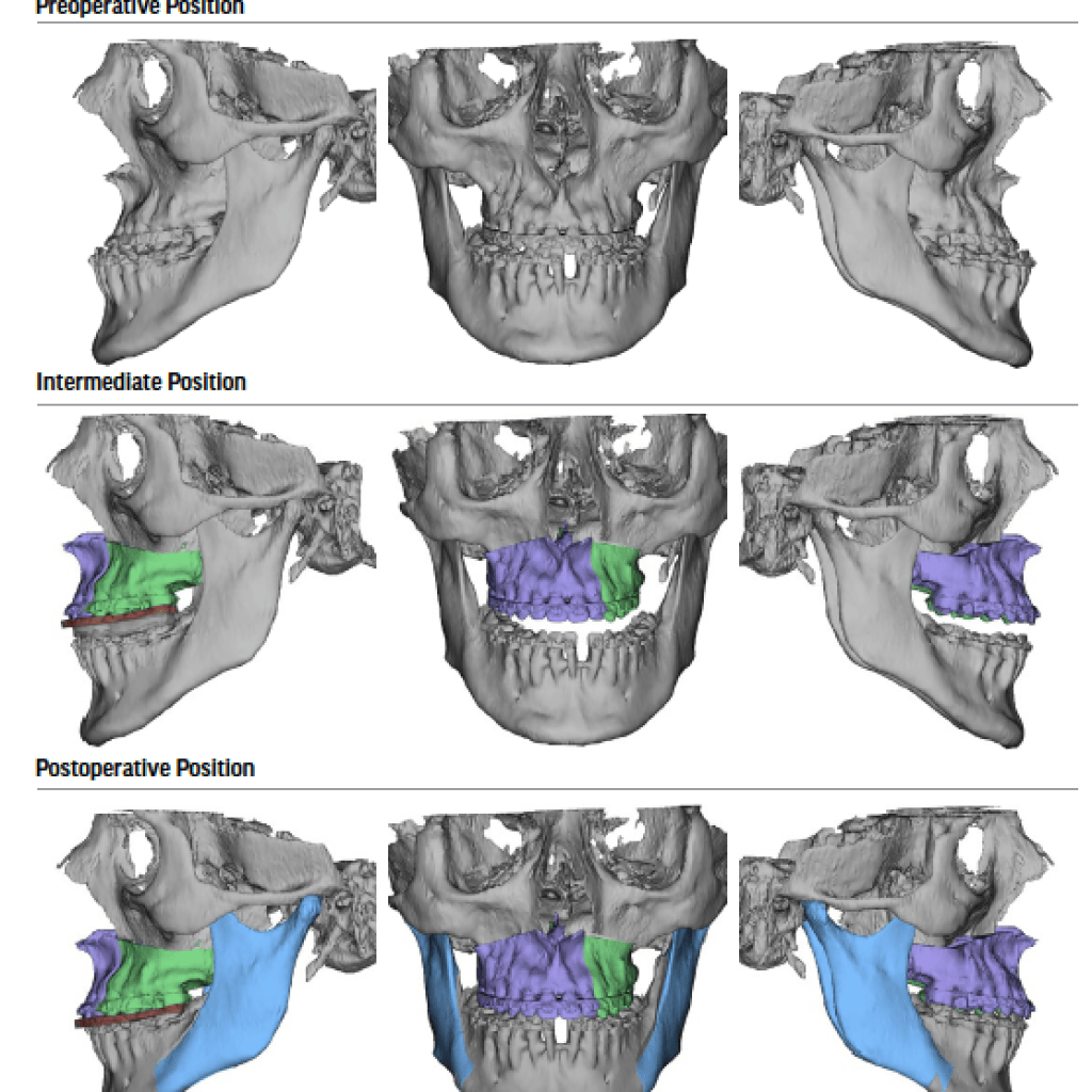 Virtual surgical planning showing preoperative, intermediate and postoperative jaw positions