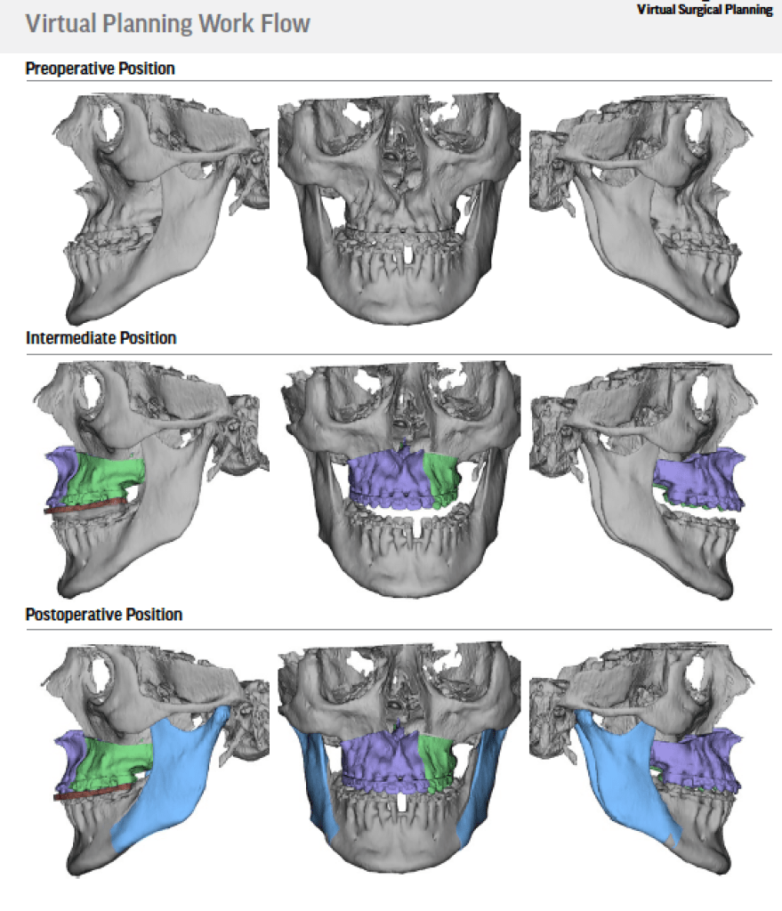 Before & After Oral Surgery Pictures Central Jersey | CJOMS